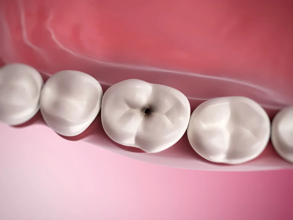 ¿Se puede revertir una caries? Los dentistas lo aclaran